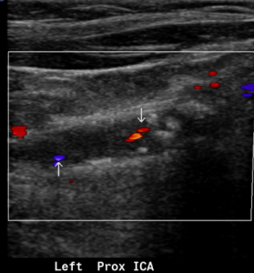 Neck Ultrasound Scan may detect Dementia a Decade Early