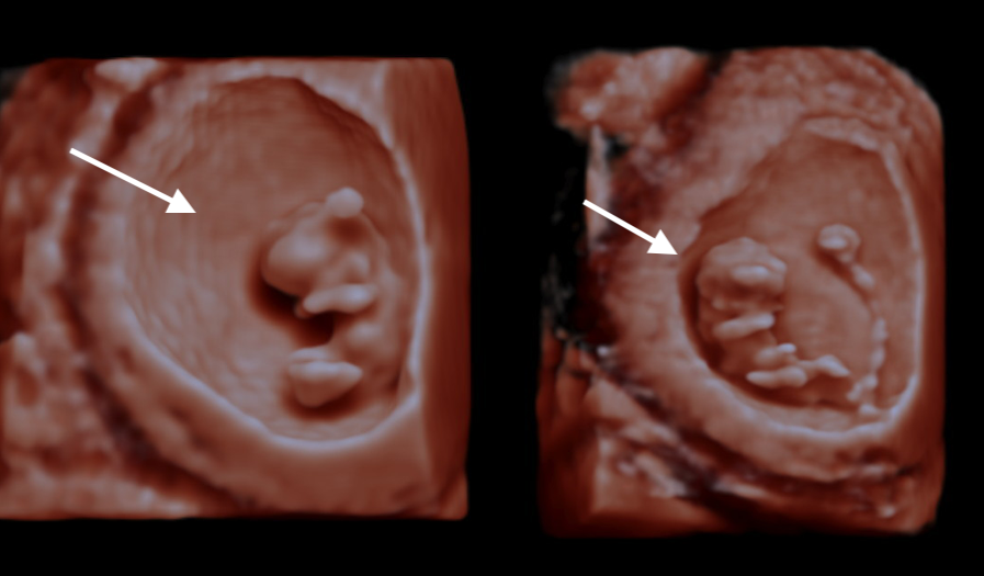 9 Weeks Ultrasound