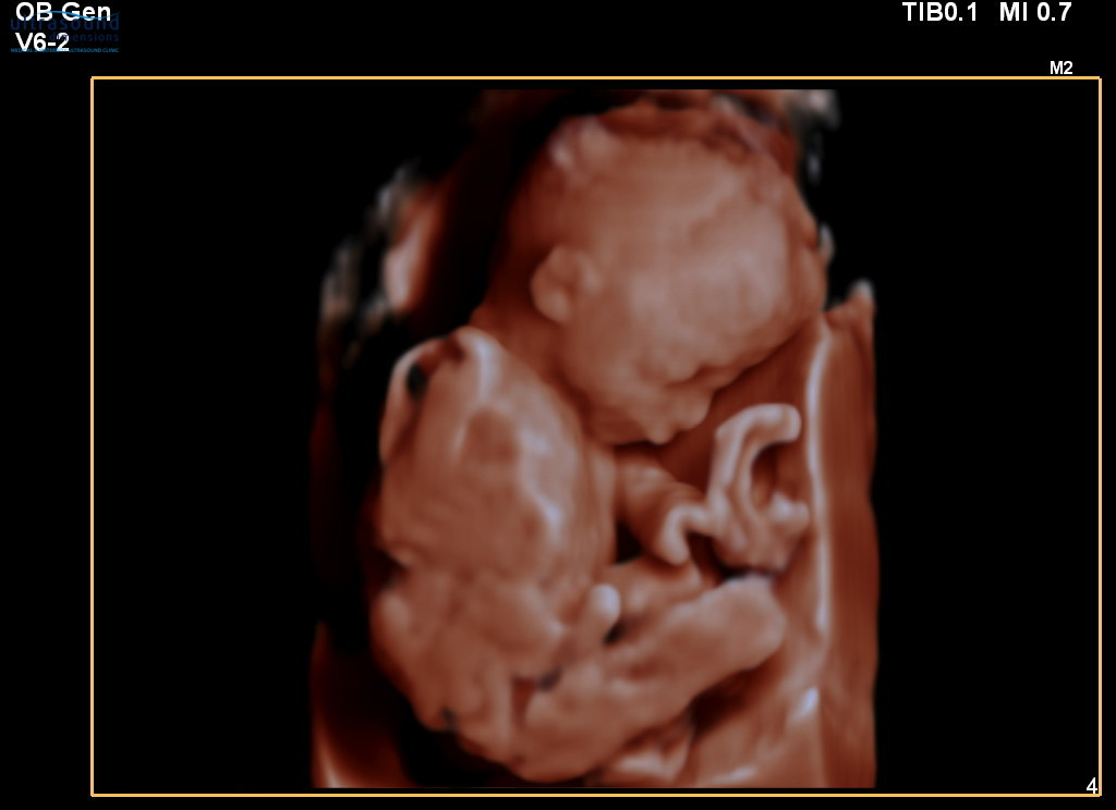 20 week 3d ultrasound face