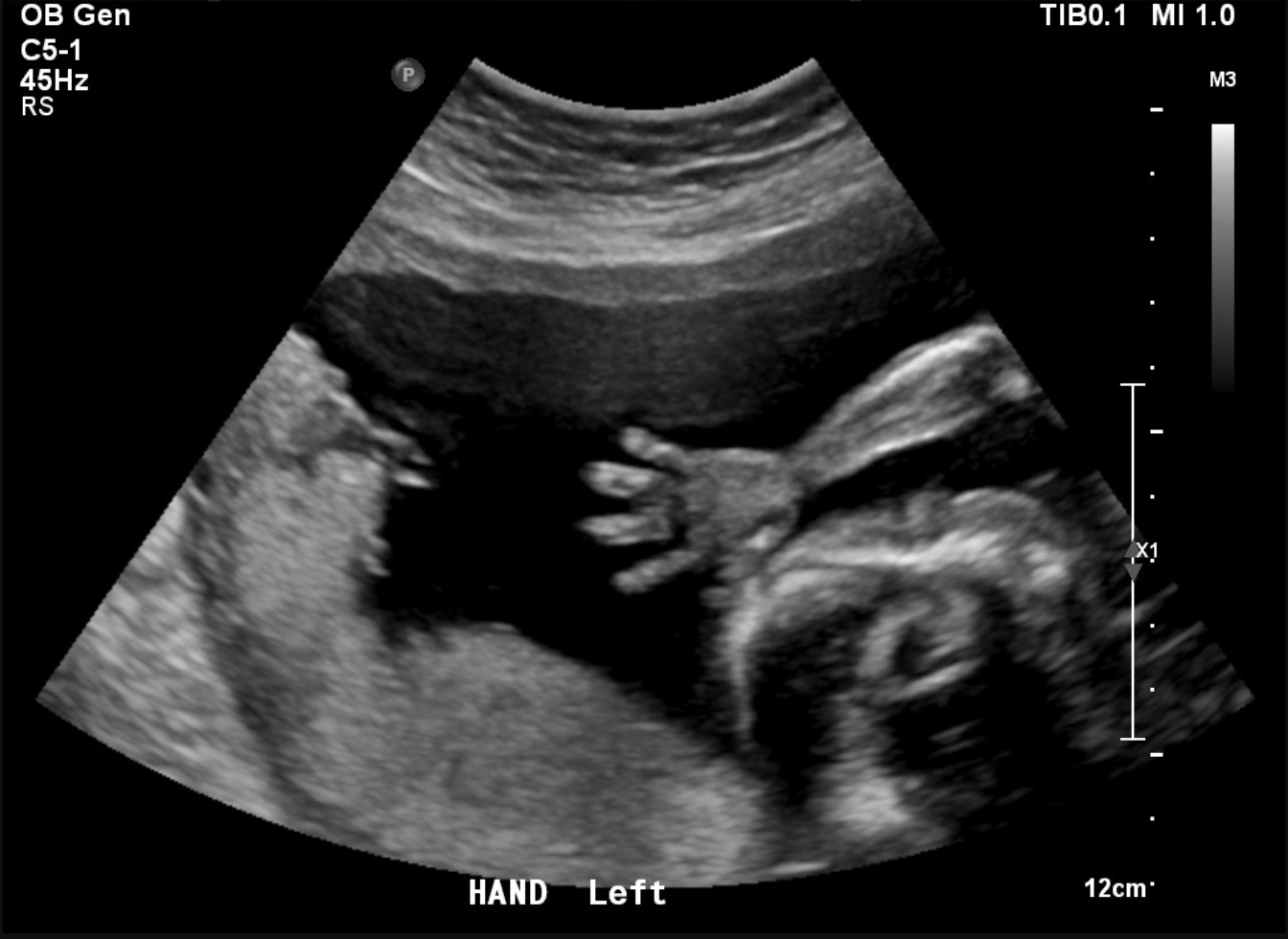 This adorable baby waving hello at 22 weeks during our Detailed Anomaly Sca...