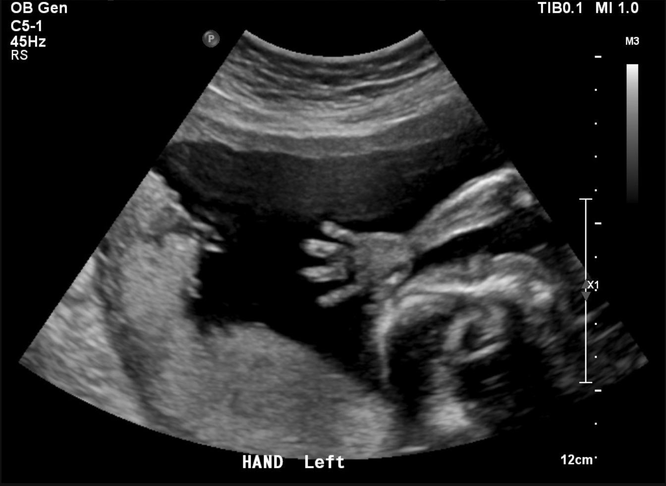 sonogram picture